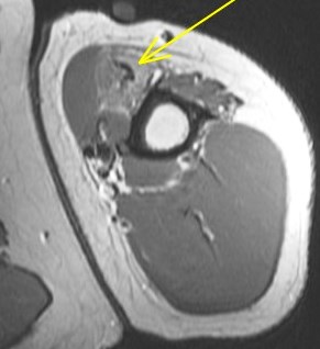 Figure 6 for case Tear of tendon of long head of biceps brachii sp tenodesis (RID1944)